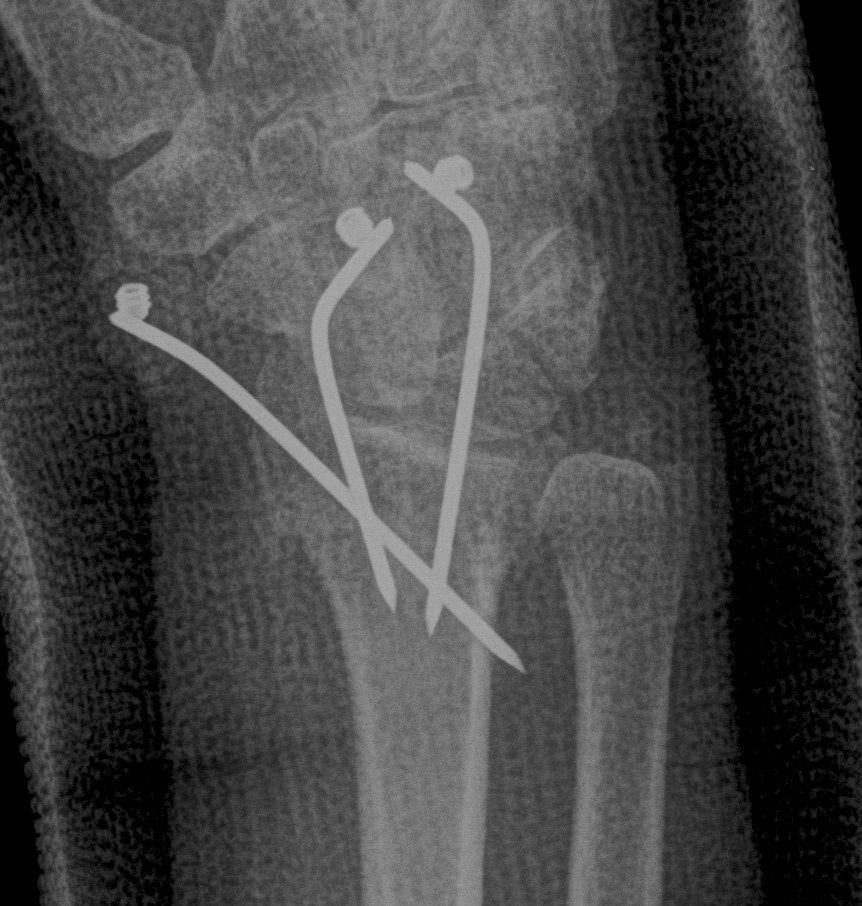 Distal Radius Fracture K wires